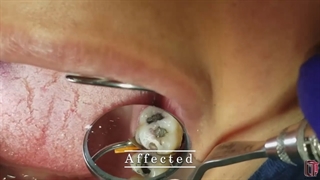 تشخیص افتراقی عاج