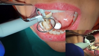 روش کاربرد کامپوزیت های bulk fill