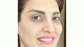 رفع کامل خط اخم ، خطوط پیشانی