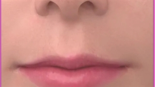 آشنایی با همه روش های لیفت لب به همراه عکس