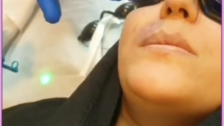 رفع ضایعات عروقی پوست