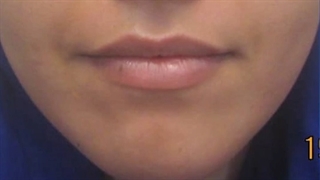 تزریق ژل لب زیبا جوی عزیزمون