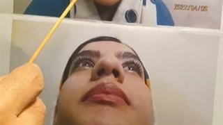 رینوپلاستی بینی گوشتی