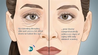 جراحی بلفاروپلاستی