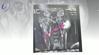 فیلم جراحی ضایعه ۱۵ ساله