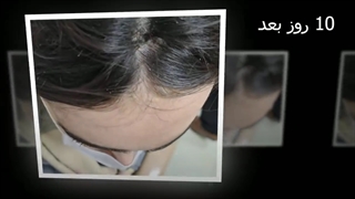 فیبروز دیسپلازی سینوس فرونتال