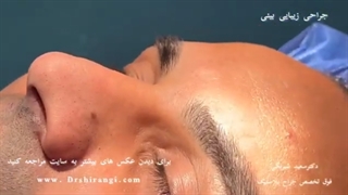 بهترین جراح بینی مردانه در تهران | دکتر سعید شیرنگی