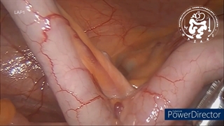 آپاندیسیت‌ / آپاندکتومی لاپاروسکوپیک