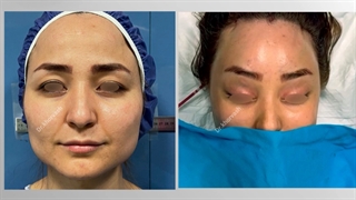 لیفت آندوسکوپی ابروها و پیشانی | دکتر خوروش