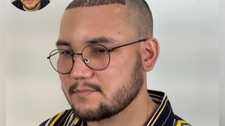 کاشت موی زیباجوی عزیز از کشور آلمان