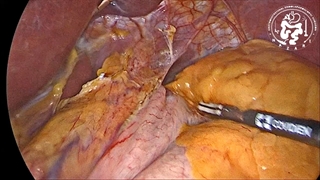 جراحی درمان آشالازی توسط دکتر نظری