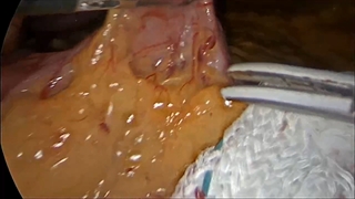 اسلیو معده در درمان چاقی توسظ دکتر نظری