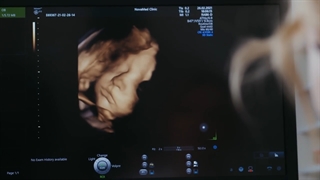 سونوگرافی کالر داپلر