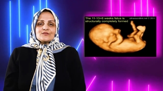 سونوگرافی (NT)