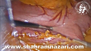 رودوزی سطوح استاپلر در عمل اسلیو گاسترکتومی