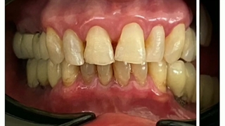 فیلم از لمینت دندان