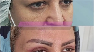 بلفاروپلاستی پلک فوقانی