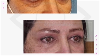 فیلم بلفاروپلاستی