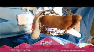 درمان عفونت و بافت نکروز با وکیوم تراپی