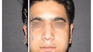 عمل بینی مردانه