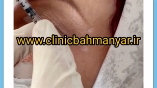 راهکارهای درمان چین و چروک دور چشم خطوط پنجه کلاغی عمل زیبایی