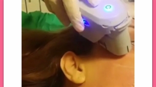 در کدام محدوده سنی می‌توان برای انجام هایفوتراپی اقدام کرد؟