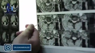 جراحی دیسک گردن| دکتر اشکان خواجو