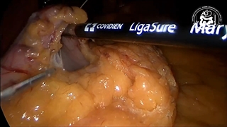 بهترین دکتر اسلیو معده تمام اصول جراحی ایمن را رعایت میکند