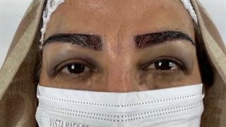 کاشت ابرو طبیعى