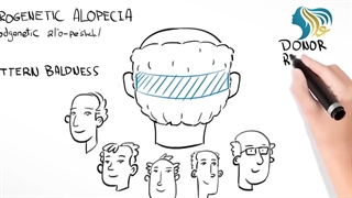 کاشت مو به زبان ساده