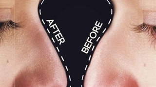 تزریق فیلر بینی