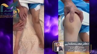 انحراف ضربدری زانو و دررفتگی کشکک