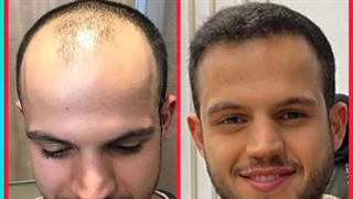 مراجعه کننده کاشت مو در کلینیک ترانسپلنت