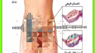 سندروم تخمدان پلی کیستیک چیست و چرا باعث ریزش مو می شود؟