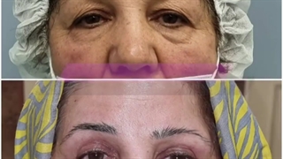 فیلم بلفاروپلاستی