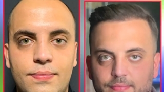 مراجعه کننده برای کاشت مو در کلینیک ترانسپلنت