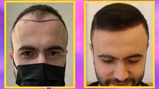 کاشت مو عوارضی ندارد در کلینیک ترانسپلنت