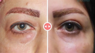 جراحی پلک پایین