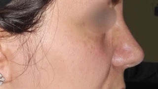 جراحی زیبایی بینی