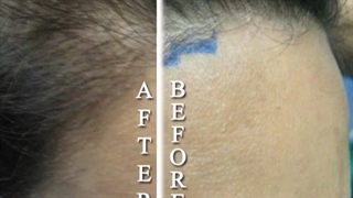 کاشت مو برای قسمت جلوی سر