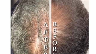 کاشت موی طبیعی