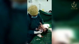 زایمان سزارین