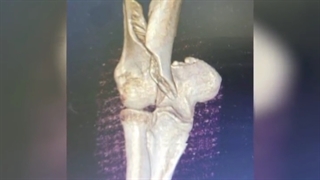 شکستگی آرنج