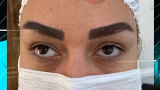 کاشت ابرو طبیعی