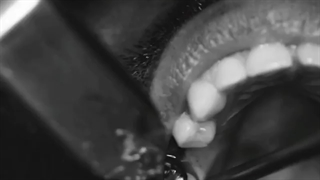 یک واحد ایمپلنت