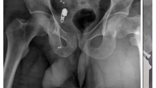 شکستگی اینترتروکانتریک و فیکساسیون با پلاک