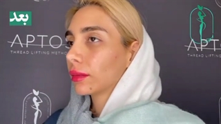 تزریق فیلر چانه و گونه متناسب سازی صورت با تزریق صحیح فیلر | دکتر جلالپور بلیچینگ