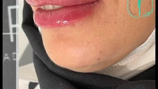 تزریق ژل لب و اصلاح فرم لب | دکتر فرشته جلالپور