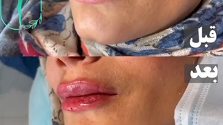 فیلم حین تزریق ژل لب | ژل لب روسی | دکتر فرشته جلالپور
