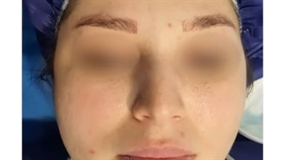 2 ماه بعد از جراحی زیبایی بینی